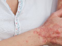 <b>过敏、湿疹也有优势？英国大型研究：这些疾病能大幅降低新冠肺炎风险</b>
