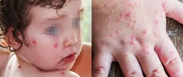 印度再爆恐怖怪病「番茄病毒」《柳叶刀》：专挑儿童下手