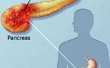 胰腺癌新进展：日本发明新疗法让癌细胞自己“吃药”