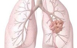 研究人员发现肺癌致病基因：EPHA3突变体