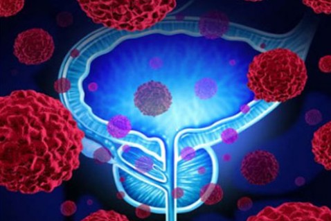 顽固性前列腺癌，有望迎来新疗法