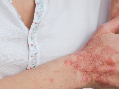 过敏、湿疹也有优势？英