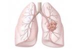 常见肿瘤基因检测规范及进展：肺癌EGFR