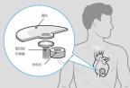 无需电池的 自动心脏起搏器